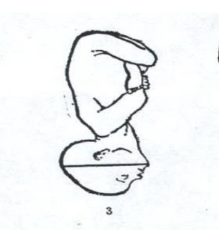 <p>cannot deliver vaginally;<strong> fetal head is partially extended, with the forehead (brow) presenting first</strong>; may require C-section</p>