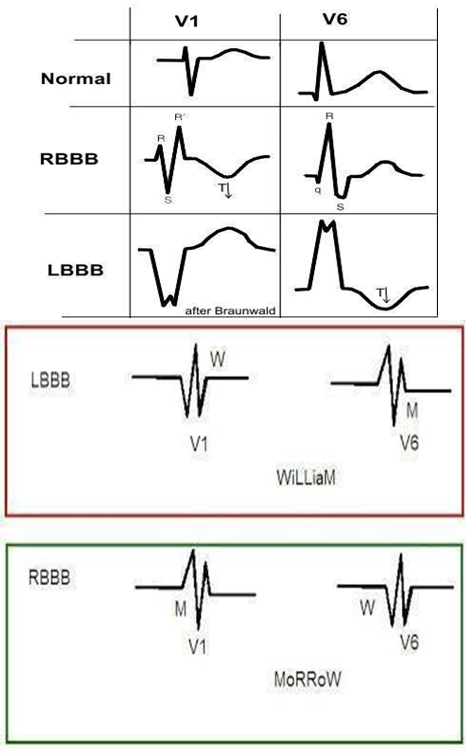 <ul><li><p class=""><strong>What is Happening:</strong></p><ul><li><p class="">First division of the ventricular conduction after the bundle of His.</p></li><li><p class="">A delay or blockage of the electrical impulses, resulting in the heart pumping blood less efficiently.</p></li></ul></li><li><p class=""><strong>Cause:</strong></p><ul><li><p class=""><strong>LBBB</strong>—MI, HTN, myocarditis, cardiomyopathy</p></li><li><p class=""><strong>RBBB</strong>—PE, MI, congenital heart defects, pulmonary HTN, myocarditis</p></li></ul></li><li><p class=""><strong>Signs &amp; Symptoms:</strong></p><ul><li><p class="">Usually asymptomatic</p></li><li><p class="">Dizziness, syncope</p></li></ul></li><li><p class=""><strong>Treatment:</strong></p><ul><li><p class="">Usually not needed if asymptomatic</p></li></ul></li><li><p><strong>Mnemonic</strong>: <strong>W</strong>illia<strong>M</strong> <strong>M</strong>orro<strong>W</strong>—<mark data-color="yellow" style="background-color: yellow; color: inherit">You need a 12 lead ECG looking at lead V1 and V6!</mark></p><ul><li><p>LBBB: V1 = W; V6 = M—90% are this!</p></li><li><p>RBBB: V1 = M; V6 = W</p></li></ul></li></ul><p>**William has L and Morrow has R</p>