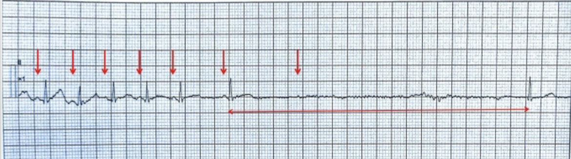 <p>absence of at least 3 cardiac cycles; P-P intervals will not march out across the rhythm strip due to SA node restarting</p>