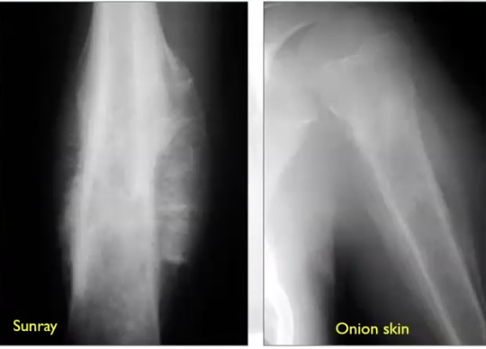 <p>What are some radiographic features of ewing sarcoma?</p>