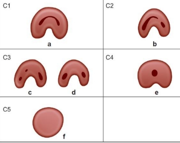 <p>C1 - uninterrupted C</p><p class="has-focus">C2 - semicolon shape</p><p class="has-focus">C3a - 2 seperate canals</p><p class="has-focus">C3b - 3 seperate canals</p><p class="has-focus">C4 - One round or oval canal</p>