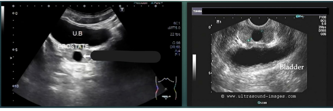 <p>Which type of cyst is shown?</p>