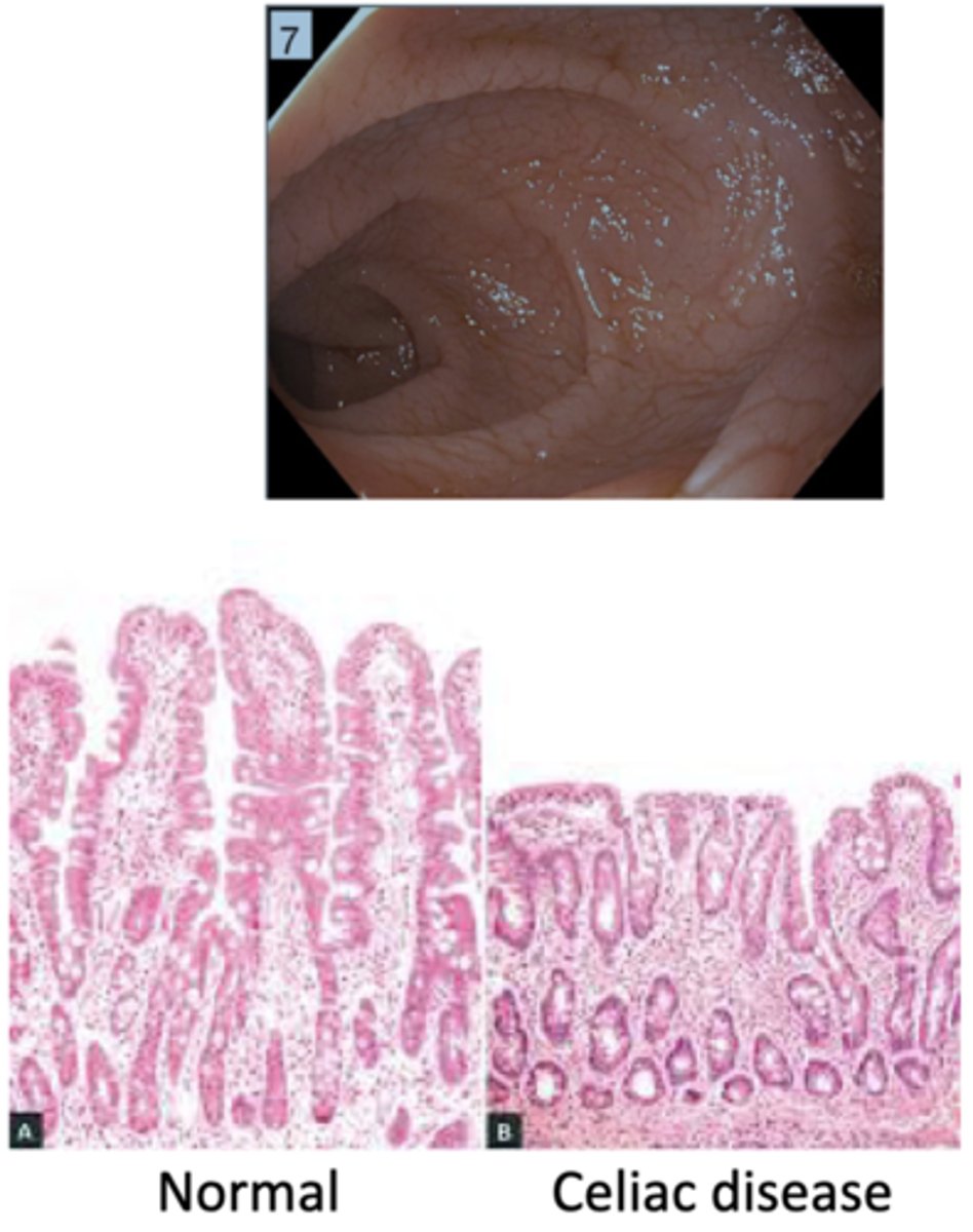 <p>blunting of intestinal villi &amp; inflammation</p><p>*common in duodenum</p>