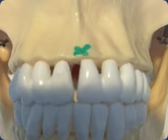 <p>Midline point at the most anterior point on the alveolar process of the maxillae</p>