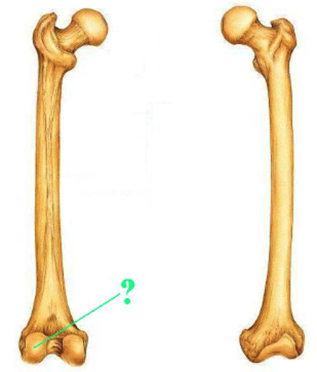 <p>lateral condyle</p>