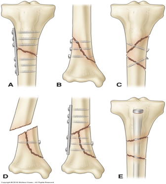 <p>fracture repair</p>