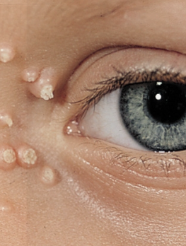 <p>Viral Skin Infections:</p><p>How do we Dx molluscum contagiosum?</p>