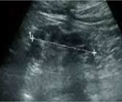<p>Renal atrophy is a ___ loss of renal tissue with preservation of ___ anatomy </p>