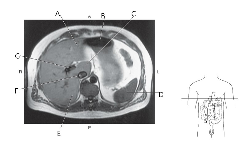 <p>IVC</p>