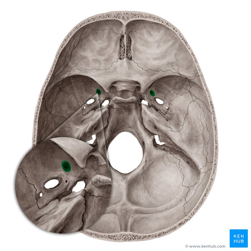 <p>Which bone landmark of the skull is a small circular hole in the greater wing of the sphenoid bone?</p>