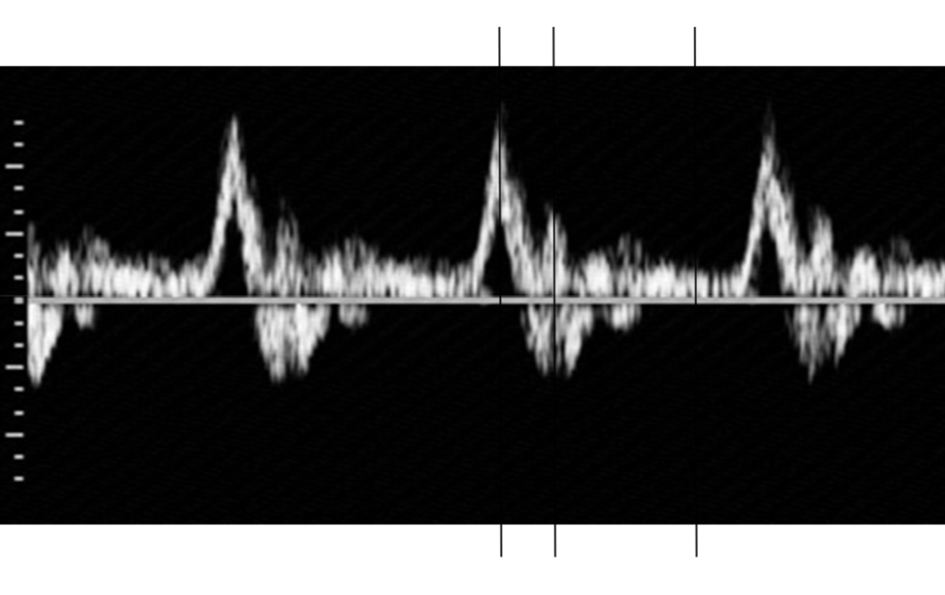 <p>Doppler signal sampled at the PRF</p><p>Fourier analysis performed on blocks of samples</p><p>Spectrum calculated for each block (each block generates a frequency spectrum) </p><p>Spectra displayed as a function of time ( displayed sequentially over time to form the spectral waveform) </p><p></p><p>Frequency spectrum: X-axis= frequency y-axis= magnitude. Magnitude/strength is shown by how many RBCS there are at that frequency ( brightness)  </p><p>Time-velocity spectral display: x-axis= time Y-axis= velocity derived from frequency shift) Pixel Brightness: Indicates RBC density at each velocity/time</p><p></p><p><strong>Frequency Spectrum: </strong>Shows the <strong>magnitude (strength)</strong> of detected frequencies <strong>at a single moment</strong>. The Time-velocity display takes sequential frequency spectra and stacks them over time to create the waveform.</p><p></p>