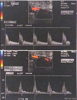 <p>The following images were documented around calcification in the SFA; the first image is before the shadowing and the second image is after. is there evidence of a hemodynamically significant stenosis under the arterial shadowing? </p>