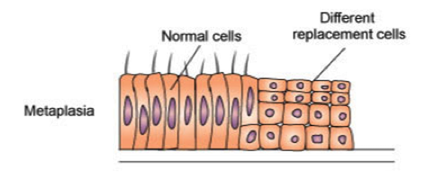 <p>only with dividing cells, change from one cell type to a different cell type (columnar to squamous), Increases the risk of cancer</p>