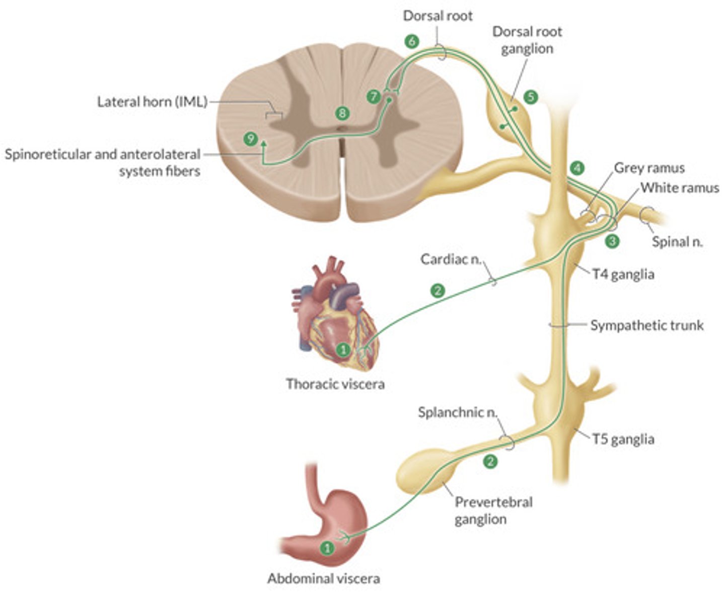 <p>Sensory Receptors in viscera are stimulated and travel toward spinal nerves in splanchnic nerves.</p><p>—they do not synapse in ganglia (sympathetic chain or Paravertebral)</p><p>Pass through white rami to join spinal nerve —>DRG</p><p>Enters spinal cord through dorsal root and synapses with secondary neuron in dorsal grey matter.</p><p>Second order neuron crosses to other side and projects to thalamus (3rd order)</p>