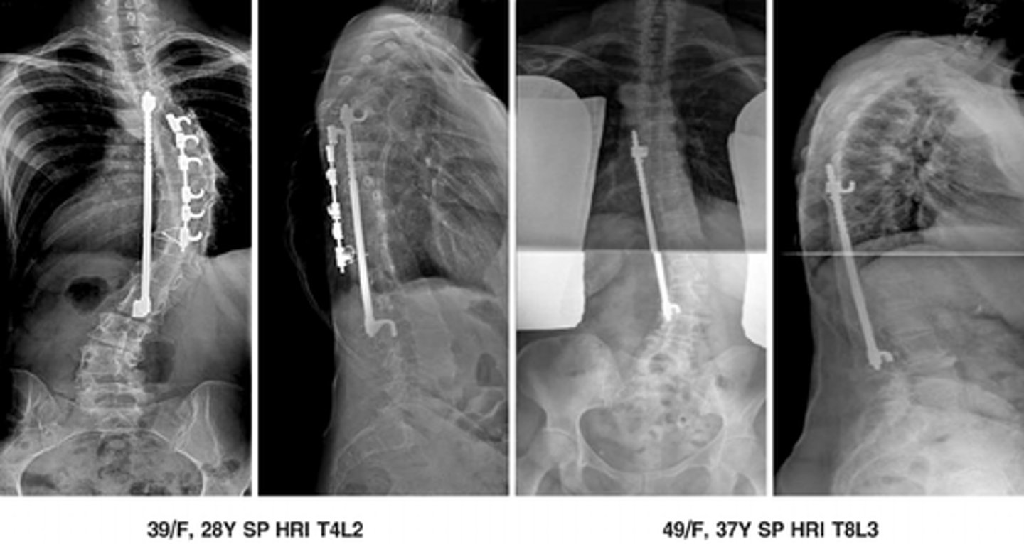 <p>for scoliosis</p>