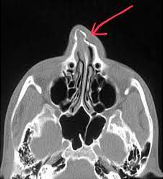 <p>hx of trauma, pain, epistaxis, pain, periorbital ecchymosis, edema, nasal obstruction</p>