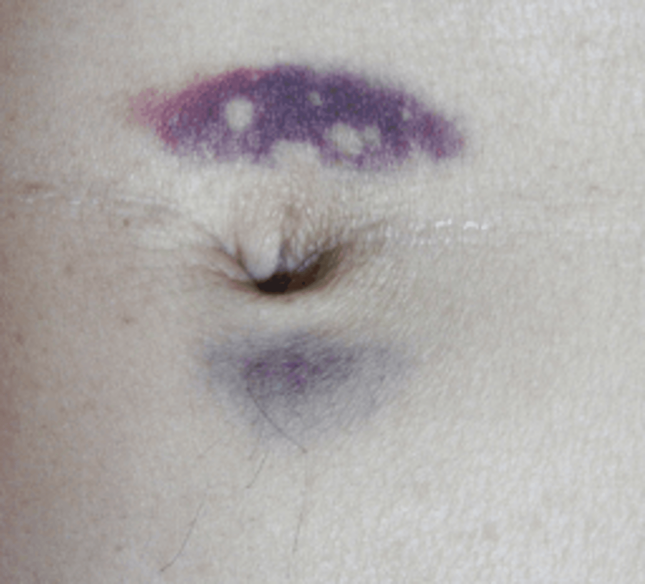 <p>bluish discoloration around umbilicus resulting from blood in peritoneal cavity b/c of hemorrhagic pancreatitis</p>