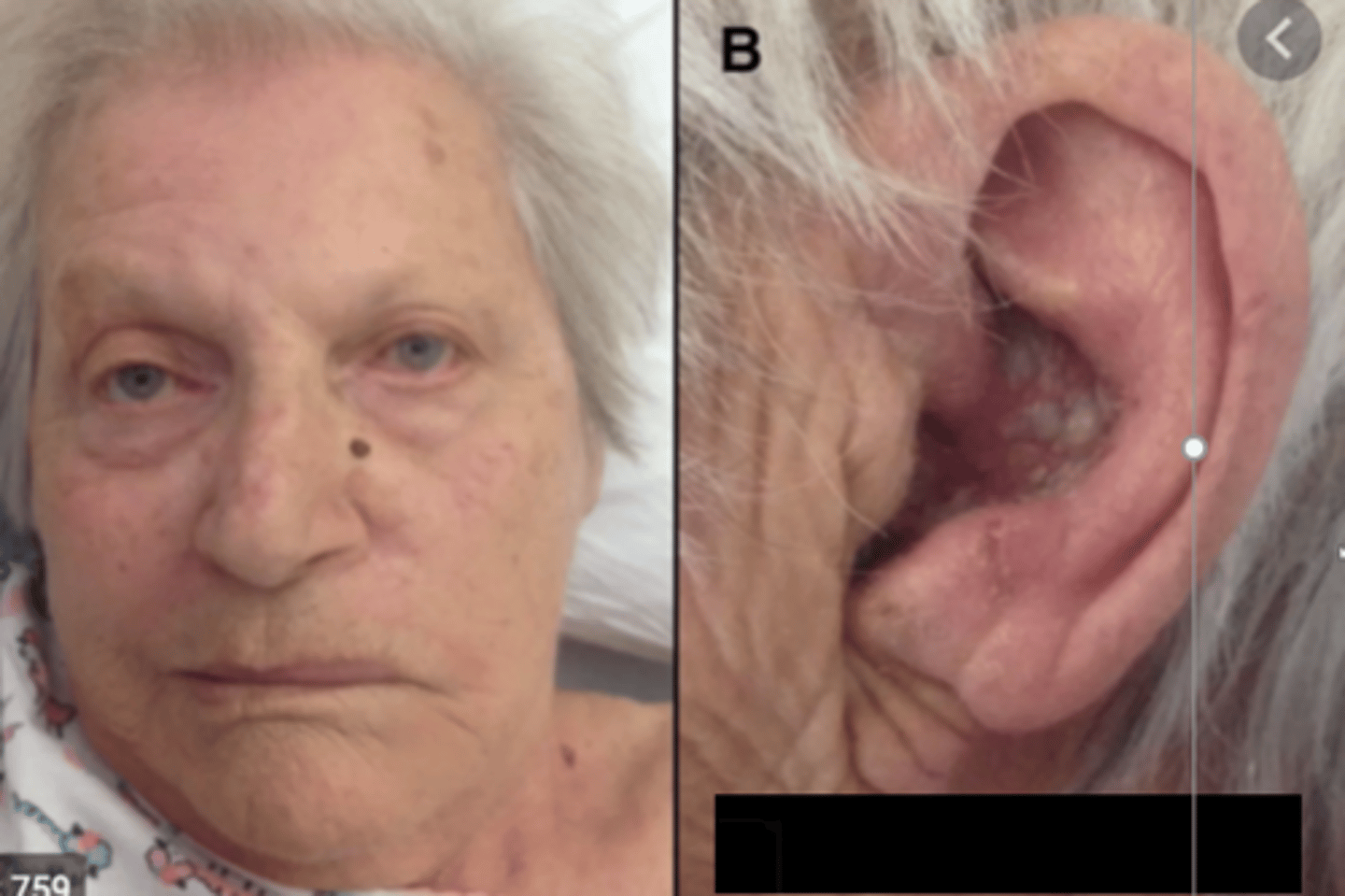 <p>A patient presents to clinic with unilateral facial paralysis and painful blisters in the external ear canal. What does this patient have?</p>