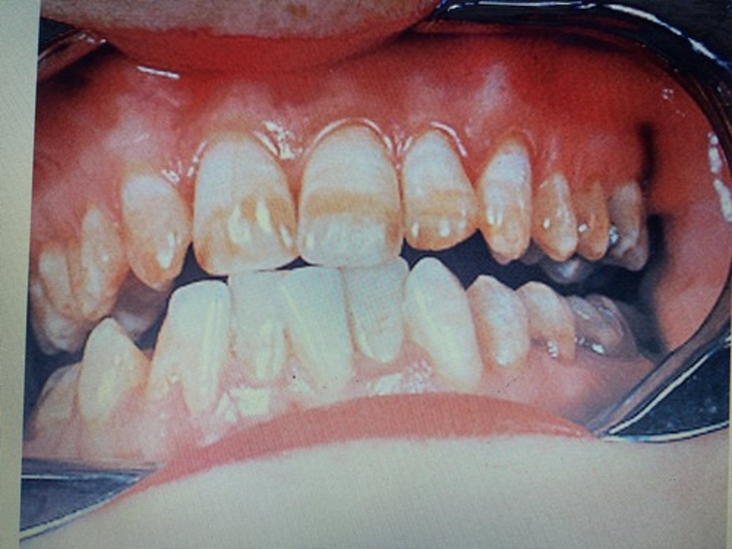 <p>Fluorosis</p>