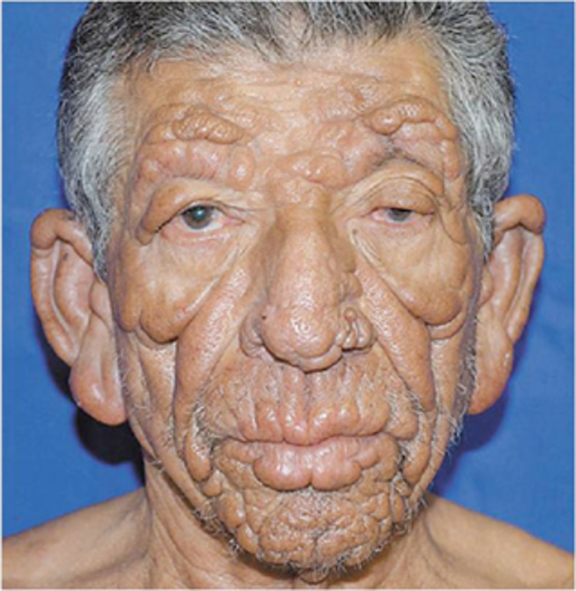 <p>Leonine facies in Lepromatous Leprosy</p>