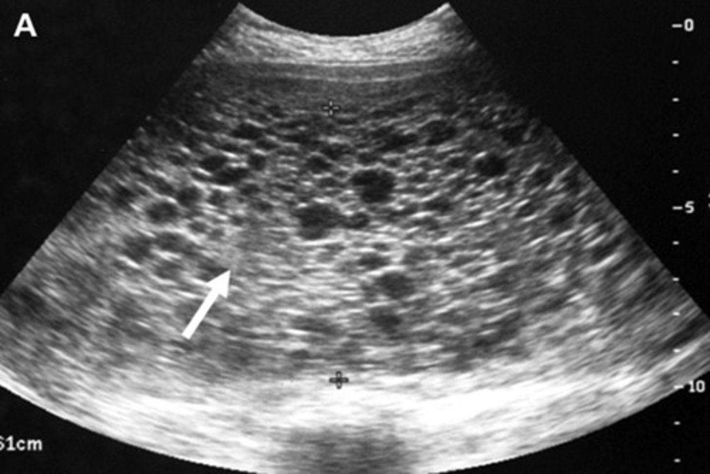 <p>Define Condition:</p><p>Multisystem disorder unique to pregnancy; varying clinical presentations</p><p>-Hx: PRIOR to 20 WGA</p><p>-Sx/PE:</p><p>&gt; CNS Sx</p><p>&gt; Pulm Edema</p><p>-Dx:</p><p>&gt; Thrombocytopenia</p><p>&gt; DIC</p><p>&gt; Elevated transaminases/other hepatic injury</p><p>&gt; Elevated Cr</p>
