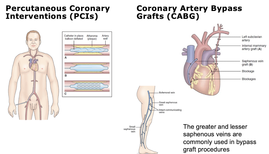 <ul><li><p>Percutaneous transluminal coronary angioplasty (PTCA): a balloon-tipped catheter is used to open blocked coronary vessels and resolve ischemia → done in cath lab</p></li><li><p>Coronary artery stent</p><ul><li><p>Stent: a metal mesh that provides structural support to a vessel at risk of closing</p></li></ul></li><li><p>Coronary artery bypass graft (CABG): a surgical procedure in which a blood vessel is grafted to an occluded (at least 50-70%) coronary artery so that blood can flow beyond the occlusion</p></li><li><p>Cardiac surgery</p><ul><li><p>Cardiopulmonary bypass (extracorporeal circulation)</p></li></ul></li></ul><p></p>