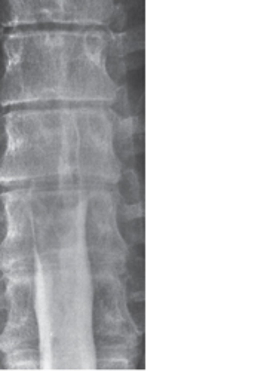 <p>What does this the AP view from a thoracic myelogram show?</p><p>A bony abnormality</p><p>An extradural mass</p><p>An intradural-extramedullary mass</p><p>An intramedullary mass</p><p>A really big disk herniation</p>