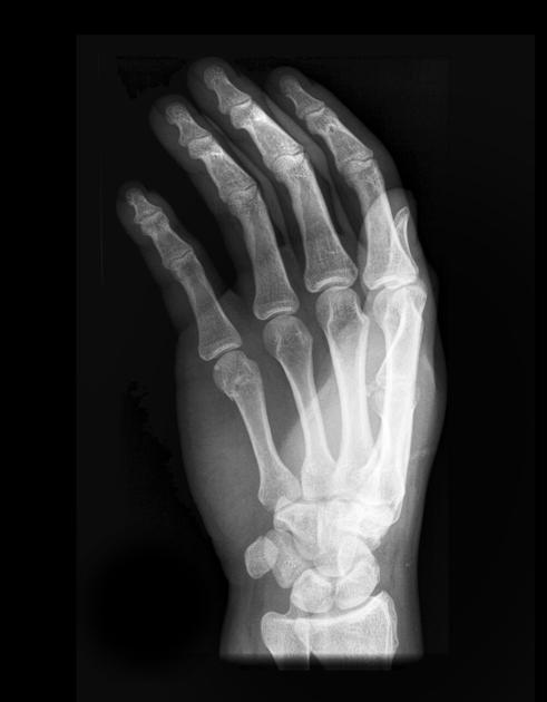 <p>Describe the abnormality demonstrated. </p>