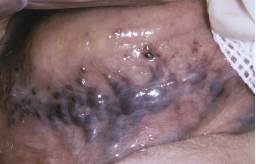 <p>Sublingual varix</p>