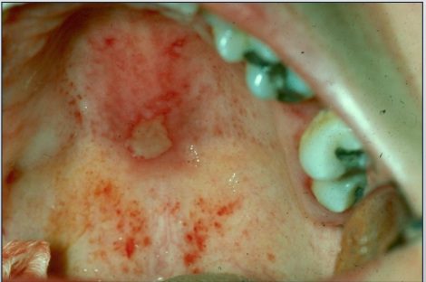 <p>Systemic Lupus Erythematosus</p>