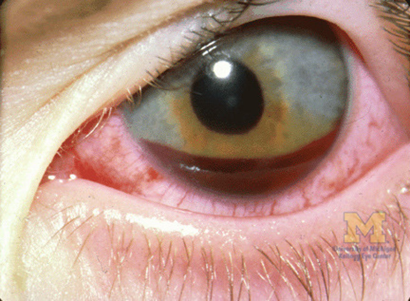 <p>Blood in the anterior chamber of the eye, usually resulting from blunt or penetrating eye injury.</p>