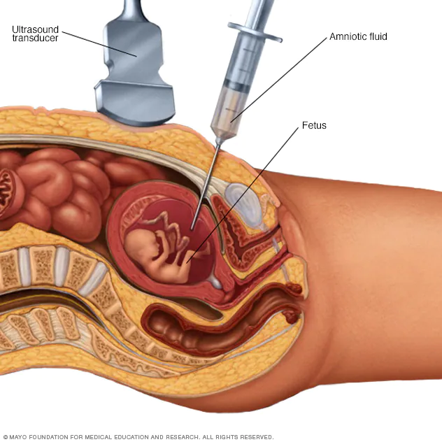 <p>During amniocentesis, an ultrasound wand (transducer) is used to show a baby&apos;s position in the uterus on a monitor. A sample of amniotic fluid, which contains fetal cells and chemicals produced by the baby, is then taken for testing.</p>