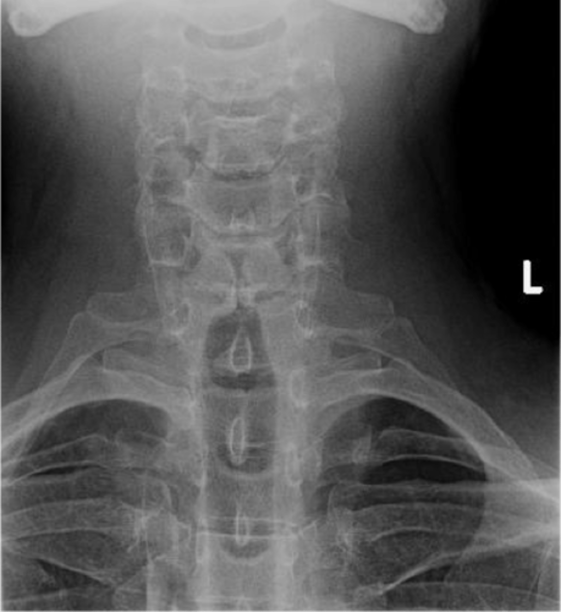 <p>Cervical ribs appearance</p>