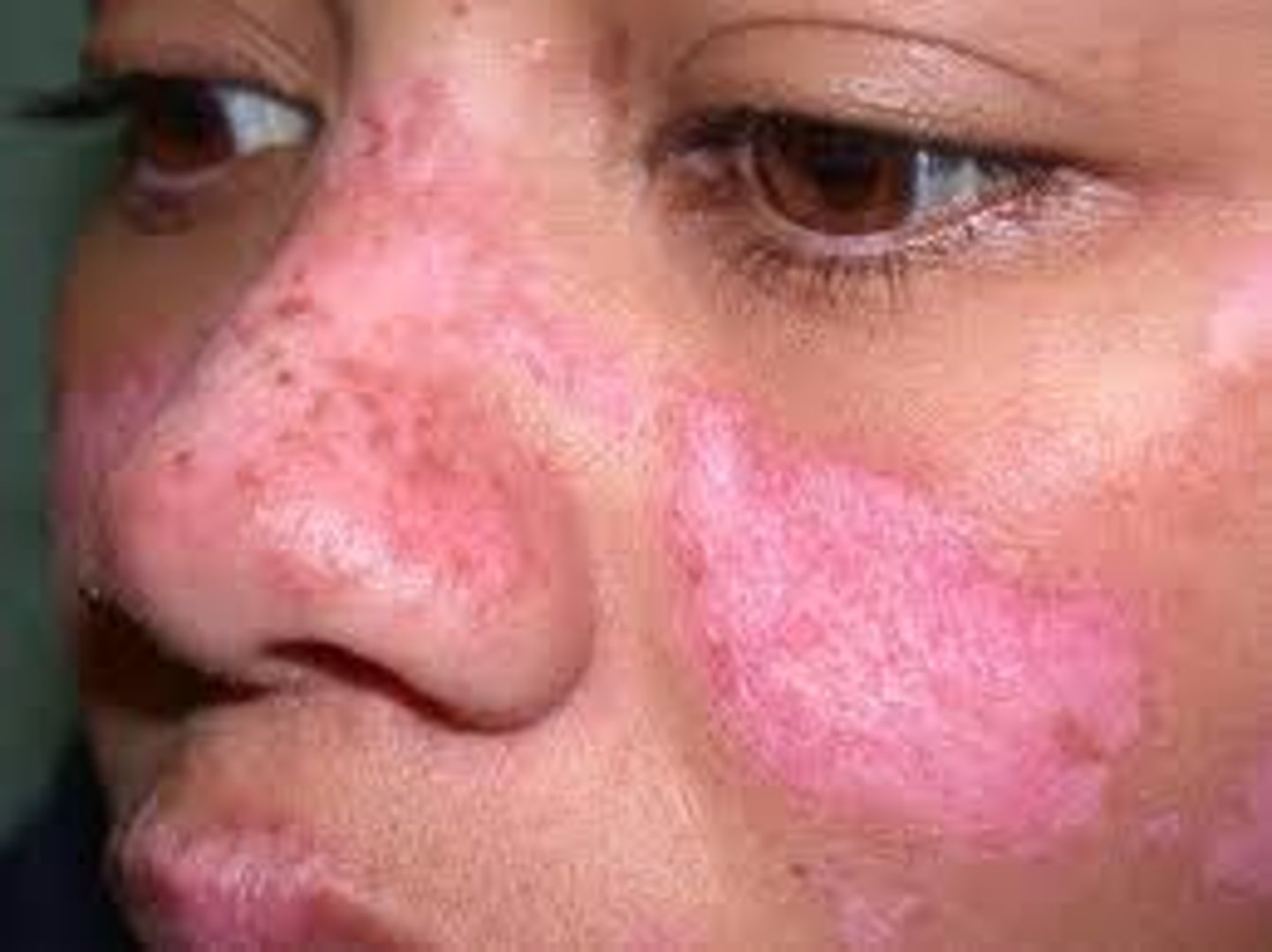 <p>Umbrella term</p><p>Discoid only affects the skin and it can get worse with sun exposures. Can cause scars. It's not systemic. Just a condition affecting the skin. May have flareups due to sun. Can leave hypo or hyper pigmentation marks. Just know it if it's in an option</p>