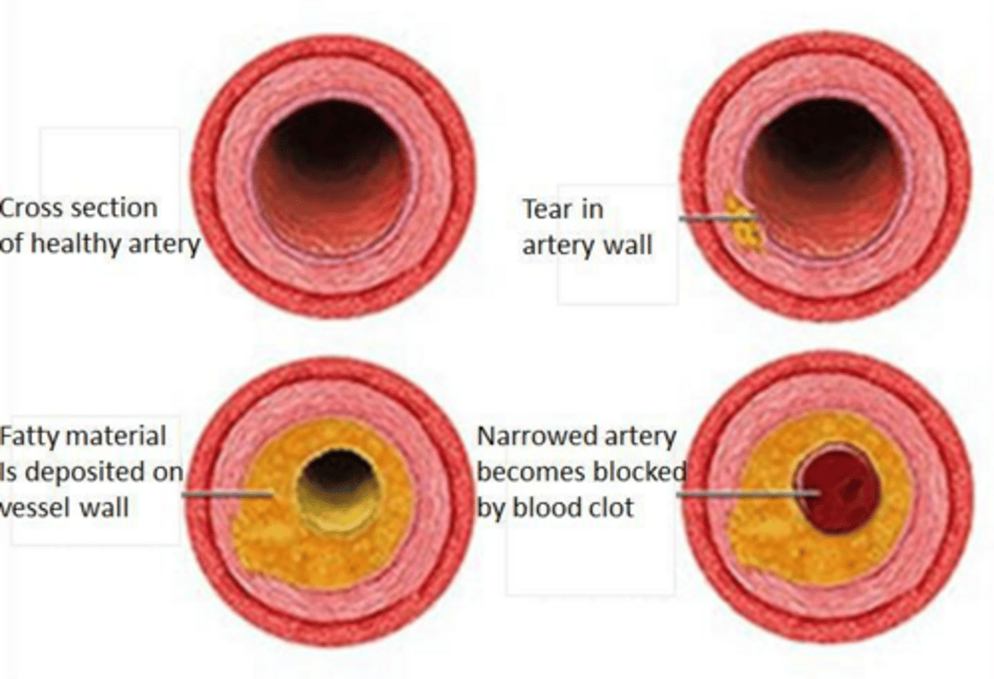 <p>Atherosclerosis, characterized by chronic inflammation and plaque formation in arterial walls.</p>