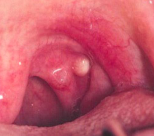 <p>smooth no ulcerated, white/yellow lesion that develops in lymphoid tissue on FOM, tonsil or netral tongue </p>