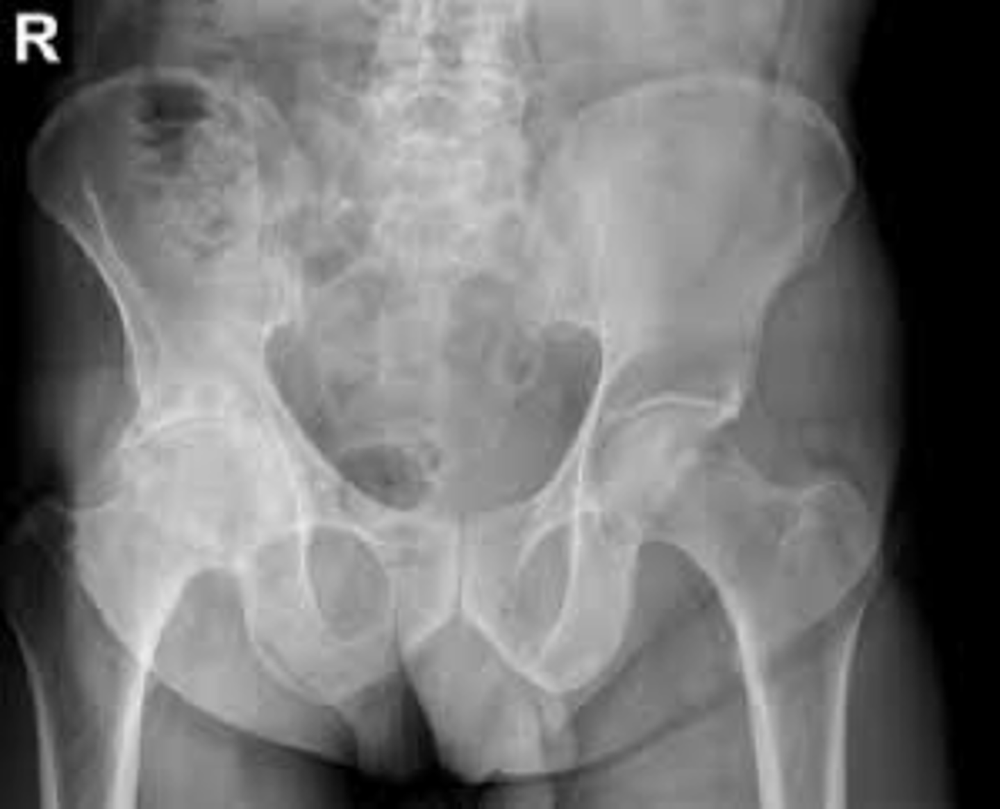 <p>joint space barely visible , subchondral sclerosis, phleboliths, cysts</p>