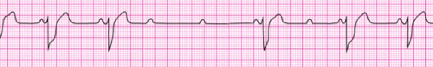 <p>You are monitoring the patient and note the rhythm below on the cardiac monitor. She has dizziness and her blood pressure is 80/40 mm Hg. She has an IV in place. What is your next action?</p><p>1. Start transcutaneous pacing.</p><p>2. Give atropine 1 mg IV.</p><p>3. Give atropine 0.5 mg IV .</p><p>4. Administer sedation and begin immediate transcutaneous pacing at 80/min.</p><p>5. Start dopamine at 2 to 10 mcg/kg per minute and titrate to patient response.</p>