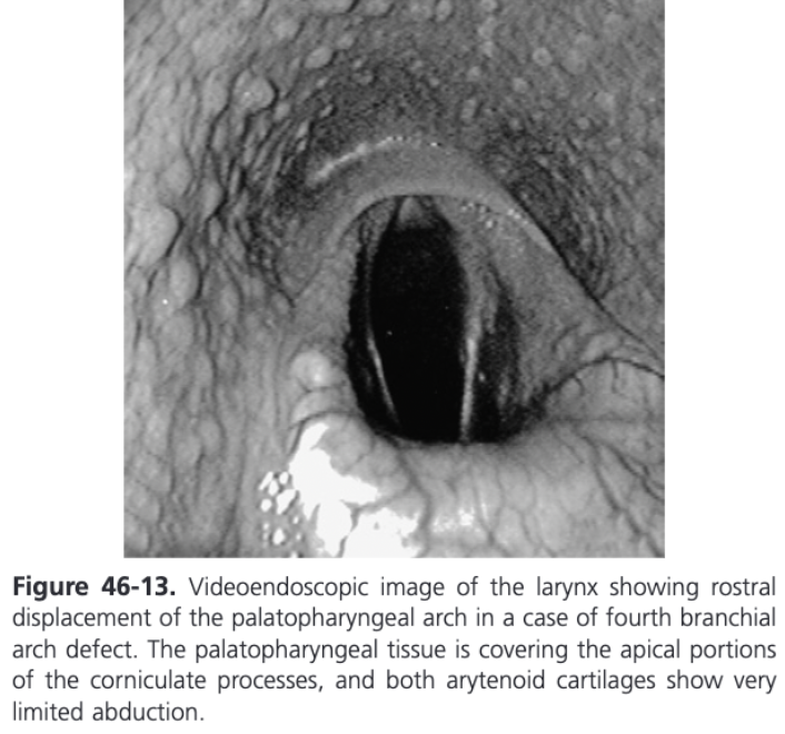 <ul><li><p><span>In the horse, the lateral wings of the thyroid cartilage, cricoarytenoid articulation, the cricoid cartilage, and the cricothyroideus, thyropharyngeus, and cricopharyngeus muscles are all derived from the embryological fourth branchial arch</span></p><ul><li><p><span>Abnormal development of one or more of these structures, unilaterally or bilaterally produces a syndrome defined as fourth branchial arch defects (4-BAD syndrome)</span></p></li></ul></li><li><p><span>Incidence of 0.02%</span></p></li><li><p><span>Most common presentation is exercise induced respiratory noise secondary to dynamic collapse of soft tissues or cartilaginous laryngeal tissues</span></p></li><li><p><span>CAD muscle is normal but the abnormal cartilage skeleton renders CAD contraction ineffective</span></p></li><li><p><span>Right side of the larynx is most frequently affected and bilateral involvement is more common than left-sided involvement alone</span></p></li><li><p><span>Horses with a severe deformity can show respiratory obstruction associated with collapse of the palatopharyngeal arch, failure of arytenoid abduction, vocal cord collapse, DDSP, and all of the above</span></p></li><li><p><span>Dysphagia and repeated colic because of a deformity and dysfunction of the cranial esophageal sphincter muscles (cricopharyngeus and thyropharyngeus) can be observed</span></p></li><li><p><span>Can be detected on laryngeal palpation</span></p><ul><li><p><span>Most horses have an obviously palpable deficit of the thyroid wing on one or both sides or an easily palpated gap between the cricoid and thyroid cartilages because of the absence or atrophy of the cricothyroid muscle</span></p></li></ul></li><li><p><span>Rostral displacement of the palatopharyngeal arch is commonly used to report the abnormal endoscopic findings when the caudal margin of the ostium intrapharyngeum is displaced rostral to the dorsal tips of the corniculate processes of the arytenoid cartilages</span></p></li><li><p><span>If laryngeal endoscopy indicates right-sided RLN, 4-BAD should be on the top of the differential diagnosis list until proved otherwise</span></p></li><li><p><span>Radiography can support a diagnosis of 4-BAD</span></p><ul><li><p><span>Air in the upper esophagus will be continuous with air in the pharynx as a result of dysfunction of the cranial esophageal sphincter</span></p></li><li><p><span>The palatopharyngeal arch may also be seen as a soft tissue mass rostral to the corniculate process</span></p></li></ul></li><li><p><span>Dynamic endoscopy is recommended prior to instituting treatment</span></p></li><li><p><span>No standardized surgical solution for horses with 4-BAD defects and the treatment should be tailored to the patient</span></p></li><li><p><span>Partial arytenoidectomy is the treatment recommended when obstruction by the arytneoid cartilage is noted</span></p></li><li><p><span>Some horses can respond to laryngoplasty if the thyroid lamina is removed and the cricoid cartilage is not involved in the deformity but the outcome of the surgery is unpredictable</span></p></li><li><p><span>Some horses can perform athletically, but usually not to their full potential</span></p></li><li><p><span>Tie-forward ahs been suggested when DDSP is observed</span></p></li><li><p><span>Laser resection of the palatopharyngeal arch is useful when dynamic collapse of the palatopharyngeal arch is identified with dynamic videoendoscopy without significant collapse of the arytenoid cartilages</span></p></li></ul>