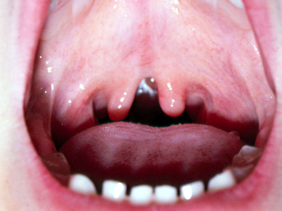 <p>what is the submucous cleft palate </p>