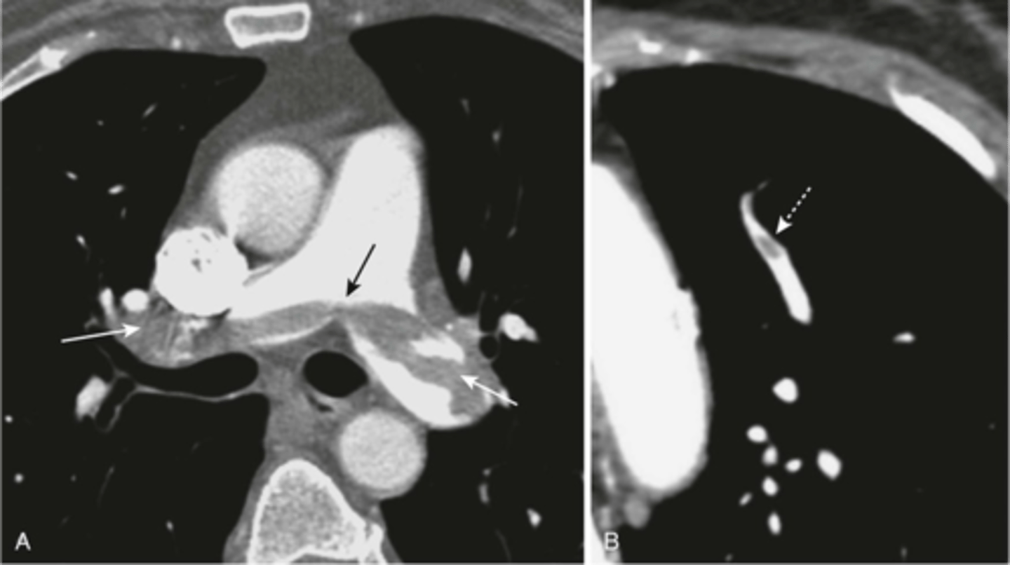 <p>-embolus fills both pulmonary arteries (left side)</p><p>-right picture is a small embolus</p>