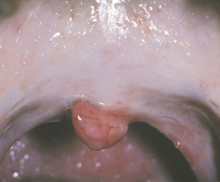 <p>chroni, progressive scarring due to BETAL QUID</p>