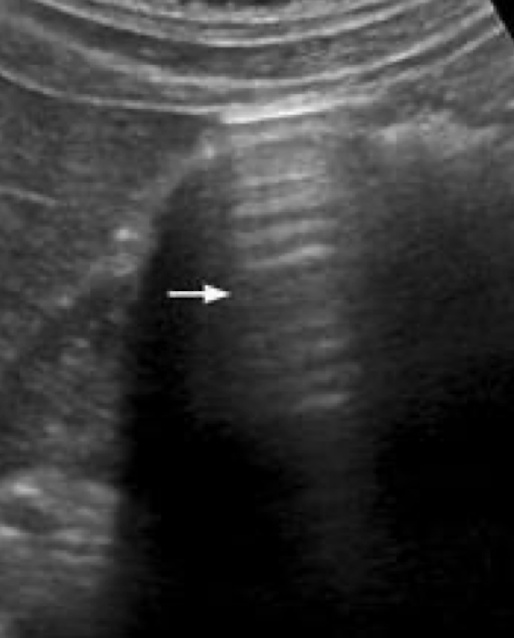 <p>reverberation artifact</p>