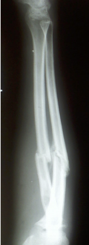 <p><span>Below is an x-ray of a forearm. Identify the two bones present in the image.</span></p>