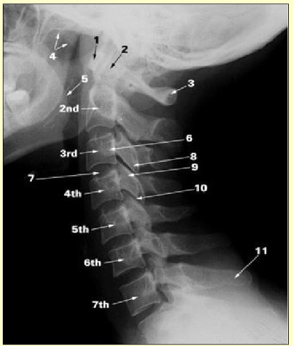 <ol><li><p>anterior arch of the atlas </p></li><li><p>dens of axis </p></li><li><p>posterior arch of atlas </p></li><li><p>soft palate </p></li><li><p>root of tongue </p></li><li><p>transverse process</p></li><li><p>intervertebral disc </p></li><li><p>inferior articular process</p></li><li><p>superior articular process </p></li><li><p>facet joint </p></li><li><p>spinous process of C7</p></li></ol><p></p>