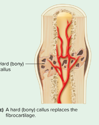 step 3 of bone repair 