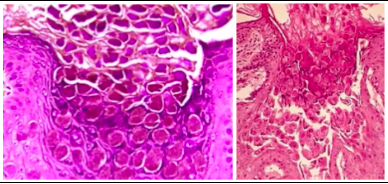 <p><span style="background-color: transparent; font-family: &quot;Times New Roman&quot;, serif;">*Millions of <strong>virions</strong> proliferate in cytoplasm of affected epithelial cells resulting in characteristic <strong>intracytoplasmic bodies</strong>&nbsp;</span></p><p><span style="background-color: transparent; font-family: &quot;Times New Roman&quot;, serif;">-these viral inclusions are the largest in all of the human body</span></p>
