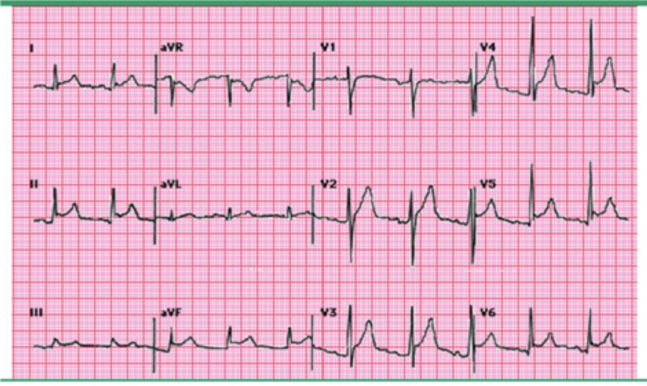 <p>Patient presents to the ER for chest pain which he describes as “Holy shit I feel like I am being stabbed in the chest!” When the head of the bed is elevated he stops screaming. Patient reports he recently got over a cold. On a physical exam you auscultate a scratchy sound at the left sternal border as well as muffled heart sounds. You also note an elevated JVP. Vitals are stable with the exception of tachycardia, hypotension, and fever. Your amazing ED tech hands you the following EKG, what do you want to order?</p>