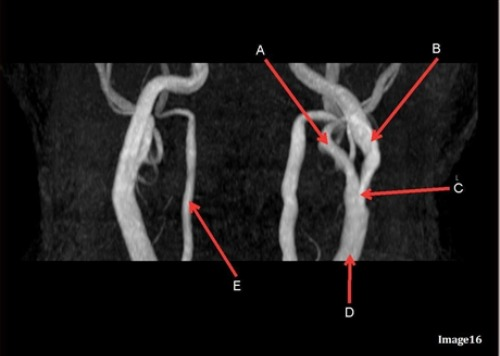 <p>Letter A in Image 16 is responsible for blood supply to the:</p><p>A. Anterior brain</p><p>B. Posterior brain</p><p>C. Face</p><p>D. Upper extremities</p>