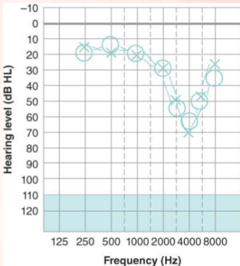 <p>What is a noise-notch hearing loss?</p>